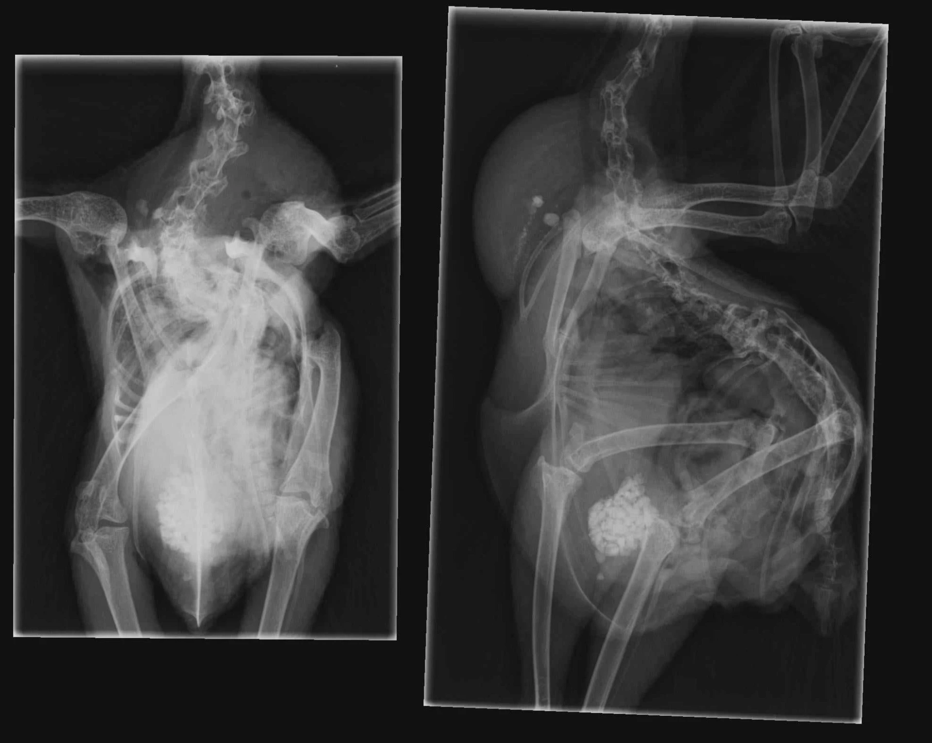 Det fläckiga på röntgen bilden tyder på Aspergillios infektion, kan ni även se den grava Skoliosen